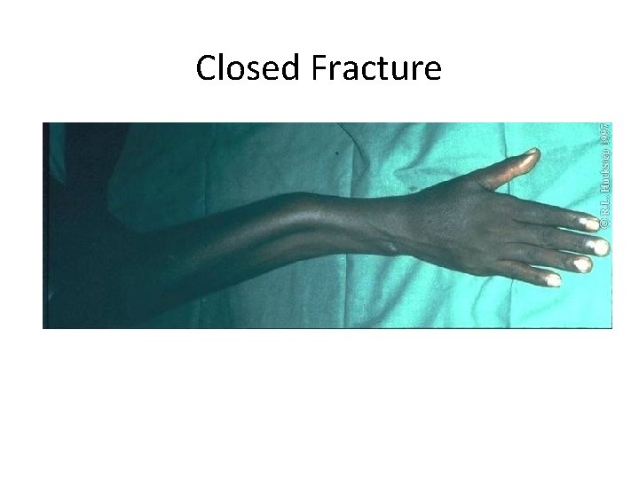 Closed Fracture 