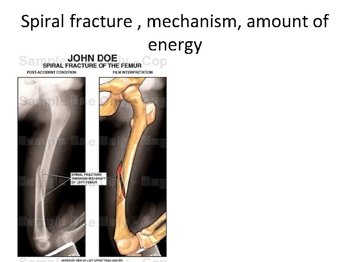 Spiral fracture , mechanism, amount of energy 