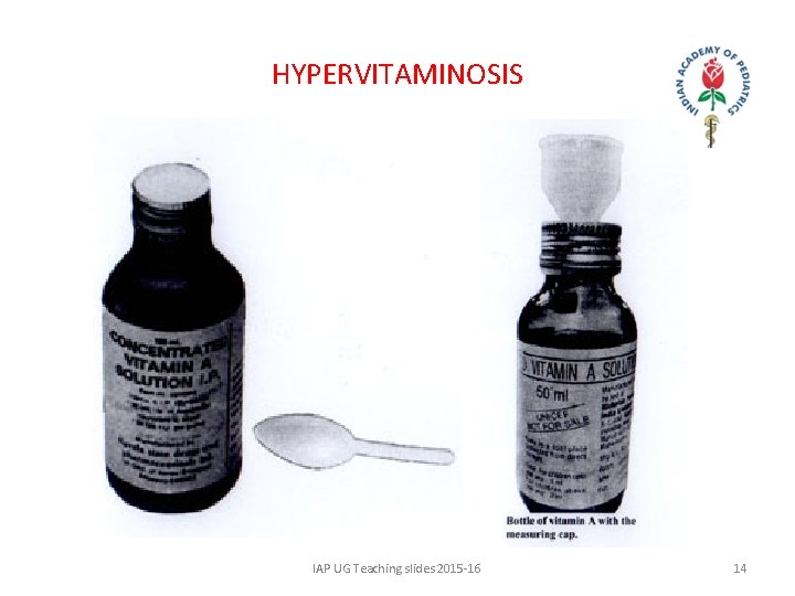 HYPERVITAMINOSIS IAP UG Teaching slides 2015 -16 14 