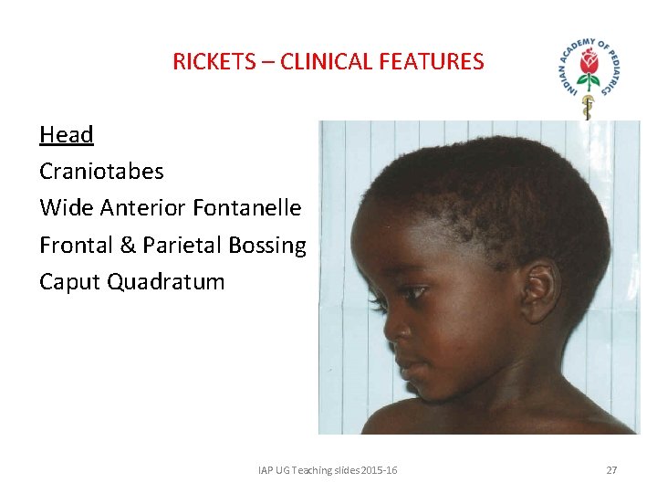 RICKETS – CLINICAL FEATURES Head Craniotabes Wide Anterior Fontanelle Frontal & Parietal Bossing Caput