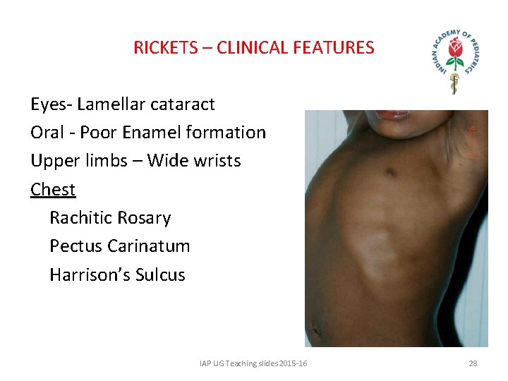 RICKETS – CLINICAL FEATURES Eyes- Lamellar cataract Oral - Poor Enamel formation Upper limbs