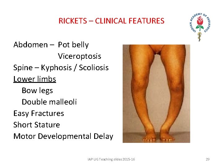 RICKETS – CLINICAL FEATURES Abdomen – Pot belly Viceroptosis Spine – Kyphosis / Scoliosis