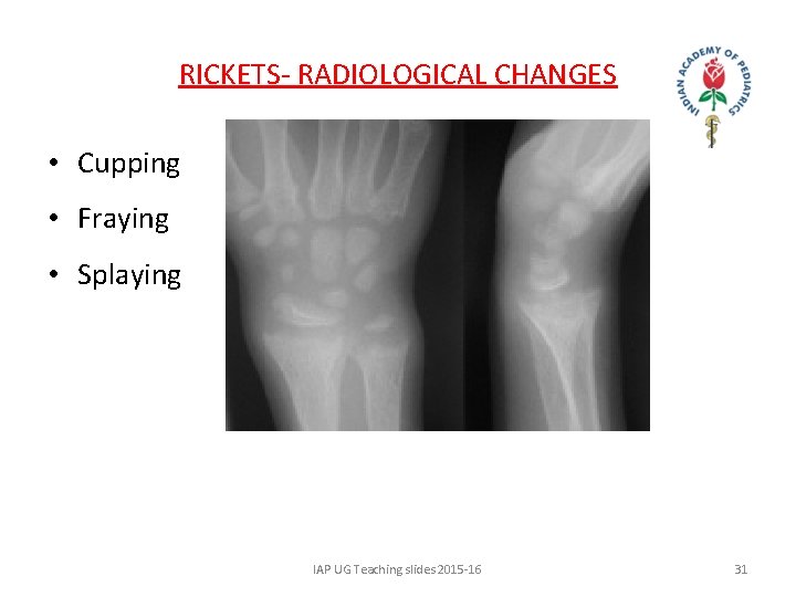 RICKETS- RADIOLOGICAL CHANGES • Cupping • Fraying • Splaying IAP UG Teaching slides 2015
