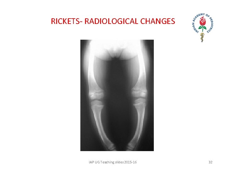 RICKETS- RADIOLOGICAL CHANGES IAP UG Teaching slides 2015 -16 32 