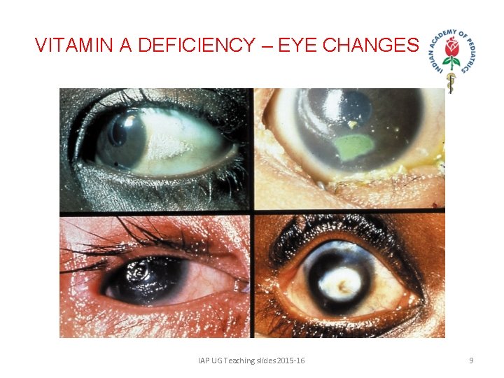 VITAMIN A DEFICIENCY – EYE CHANGES IAP UG Teaching slides 2015 -16 9 