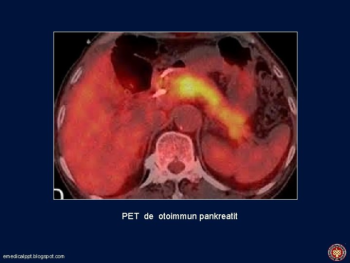 PET de otoimmun pankreatit emedicalppt. blogspot. com 