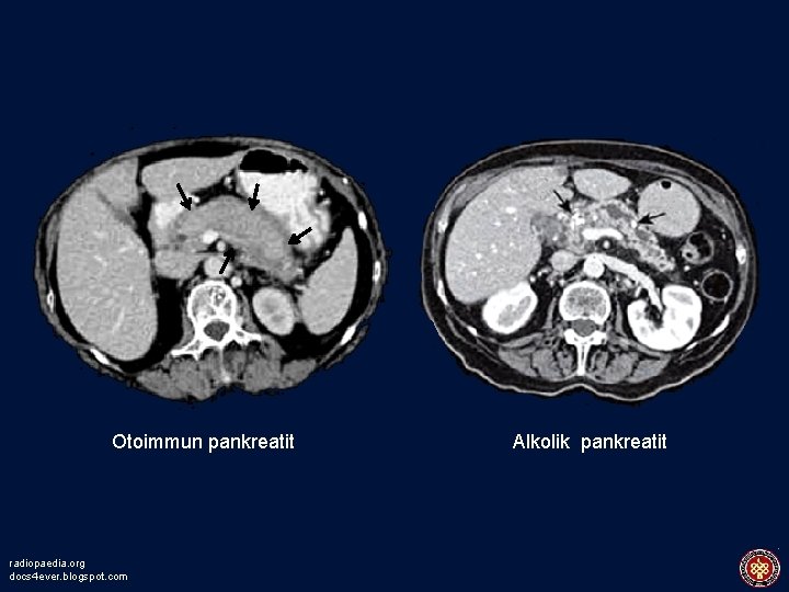 Otoimmun pankreatit radiopaedia. org docs 4 ever. blogspot. com Alkolik pankreatit 