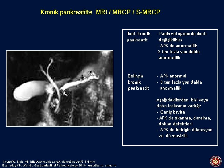 Kronik pankreatitte MRI / MRCP / S-MRCP Ilımlı kronik pankreatit - Pankreotogramda ılımlı değişiklikler