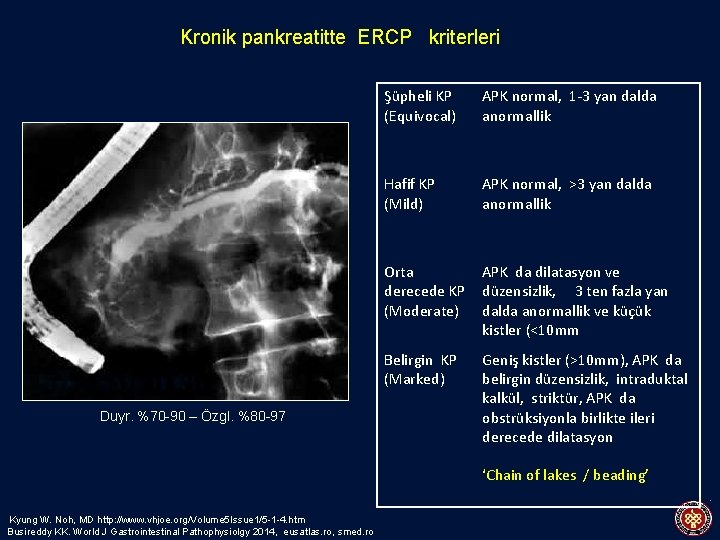 Kronik pankreatitte ERCP kriterleri Duyr. %70 -90 – Özgl. %80 -97 Şüpheli KP (Equivocal)