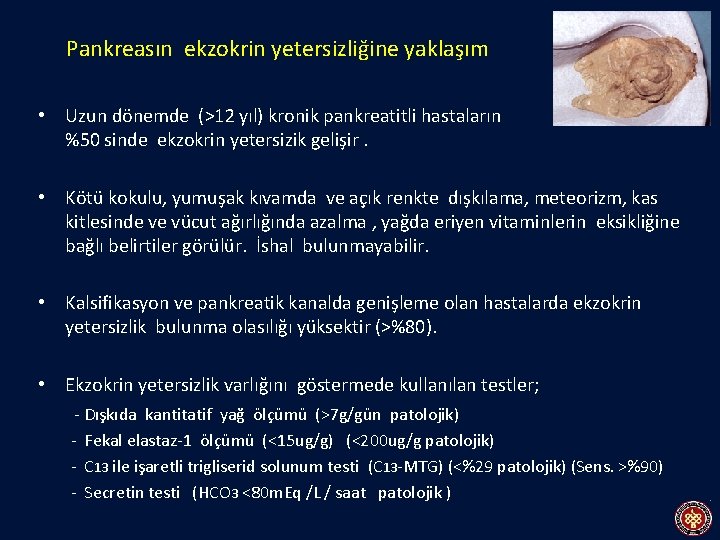 Pankreasın ekzokrin yetersizliğine yaklaşım • Uzun dönemde (>12 yıl) kronik pankreatitli hastaların %50 sinde