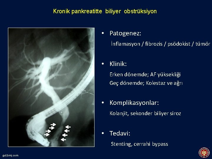 Kronik pankreatitte biliyer obstrüksiyon • Patogenez: İnflamasyon / fibrozis / psödokist / tümör •