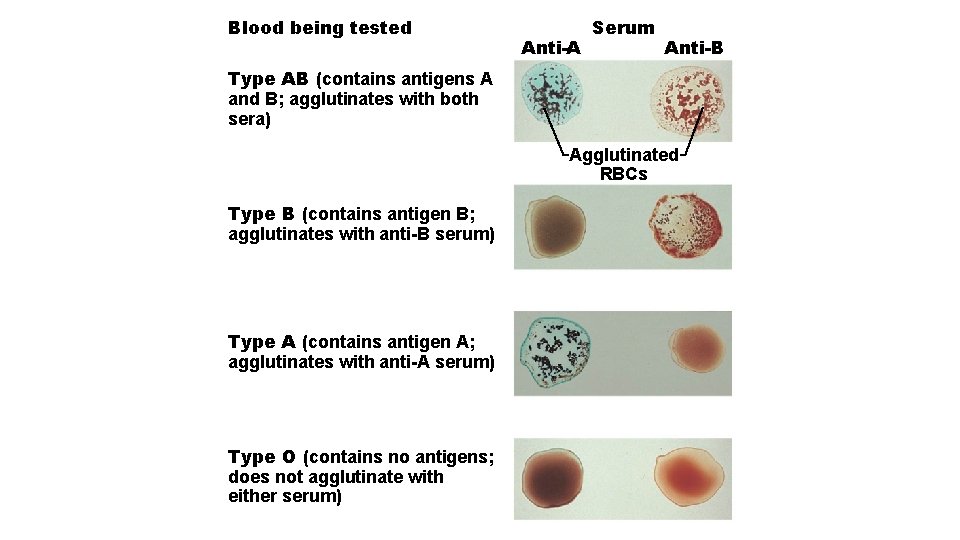 Blood being tested Anti-A Serum Anti-B Type AB (contains antigens A and B; agglutinates
