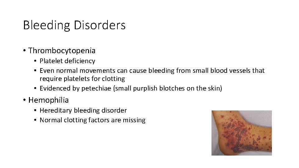 Bleeding Disorders • Thrombocytopenia • Platelet deficiency • Even normal movements can cause bleeding