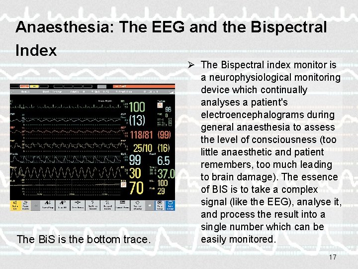 Anaesthesia: The EEG and the Bispectral Index The Bi. S is the bottom trace.