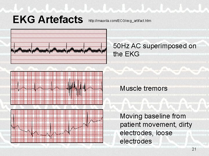 EKG Artefacts http: //mauvila. com/ECG/ecg_artifact. htm 50 Hz AC superimposed on the EKG Muscle