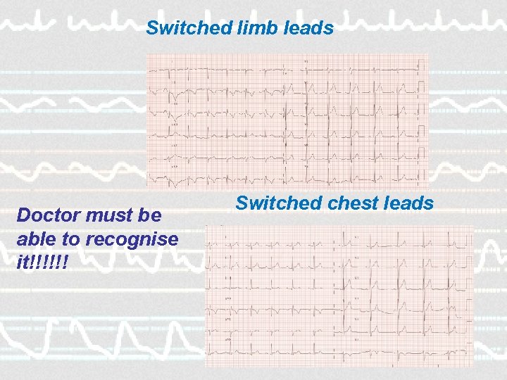 Switched limb leads Doctor must be able to recognise it!!!!!! Switched chest leads 