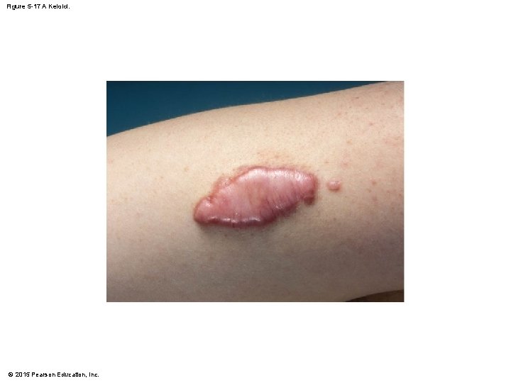 Figure 5 -17 A Keloid. © 2015 Pearson Education, Inc. Figure 5 -17 A Keloid. © 2015 Pearson Education, Inc.
