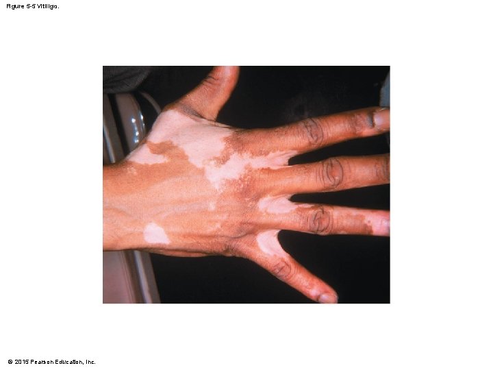 Figure 5 -5 Vitiligo. © 2015 Pearson Education, Inc. Figure 5 -5 Vitiligo. © 2015 Pearson Education, Inc.