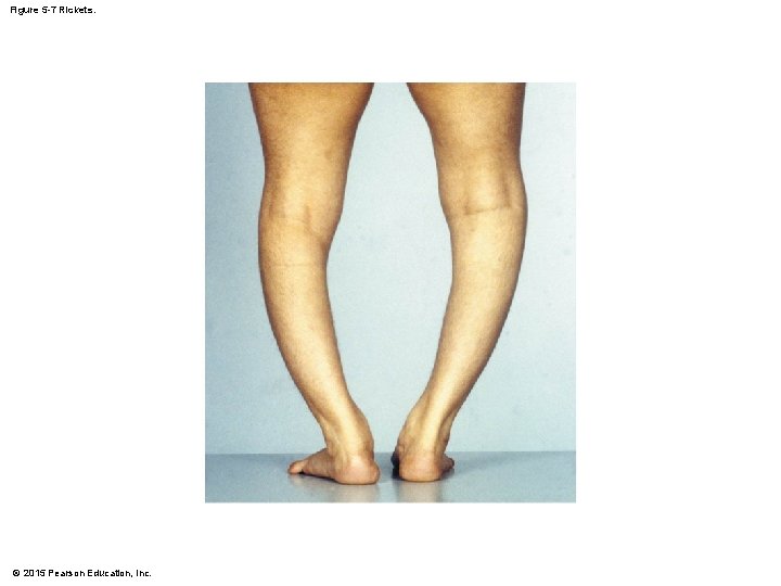 Figure 5 -7 Rickets. © 2015 Pearson Education, Inc. Figure 5 -7 Rickets. © 2015 Pearson Education, Inc.