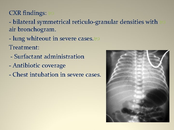 CXR findings: - bilateral symmetrical reticulo-granular densities with air bronchogram. - lung whiteout in