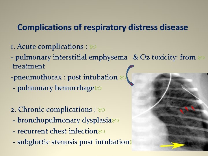 Complications of respiratory distress disease 1. Acute complications : - pulmonary interstitial emphysema &