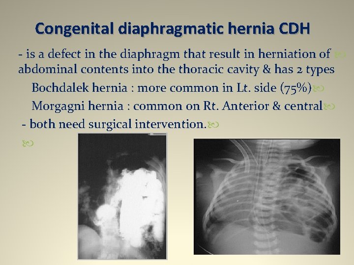Congenital diaphragmatic hernia CDH - is a defect in the diaphragm that result in