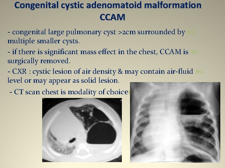Congenital cystic adenomatoid malformation CCAM - congenital large pulmonary cyst >2 cm surrounded by
