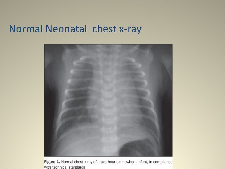 Normal Neonatal chest x-ray 