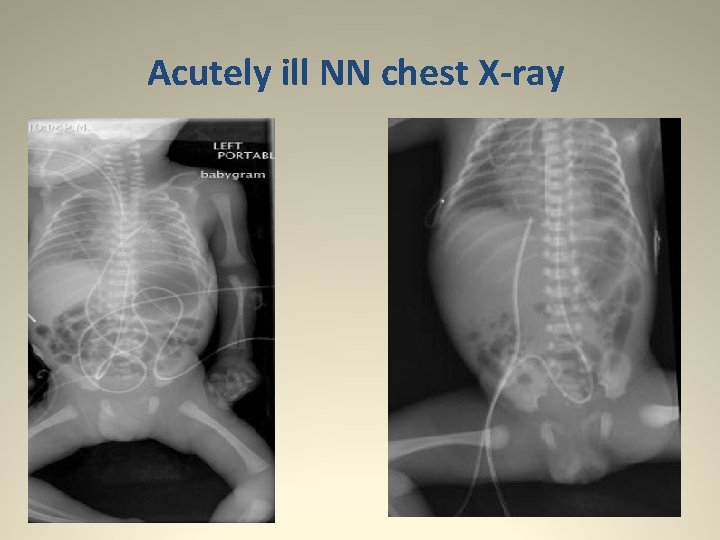 Acutely ill NN chest X-ray 