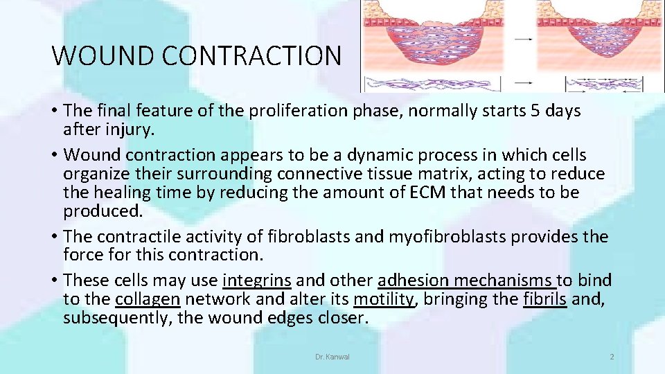WOUND CONTRACTION • The final feature of the proliferation phase, normally starts 5 days