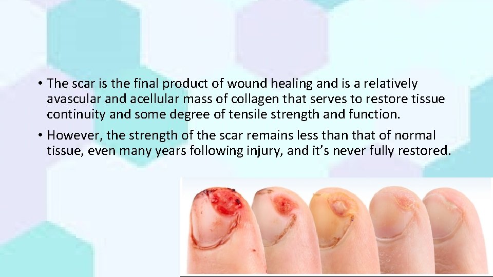  • The scar is the final product of wound healing and is a
