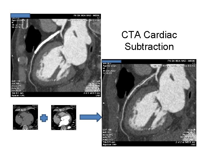 CTA Cardiac Subtraction 