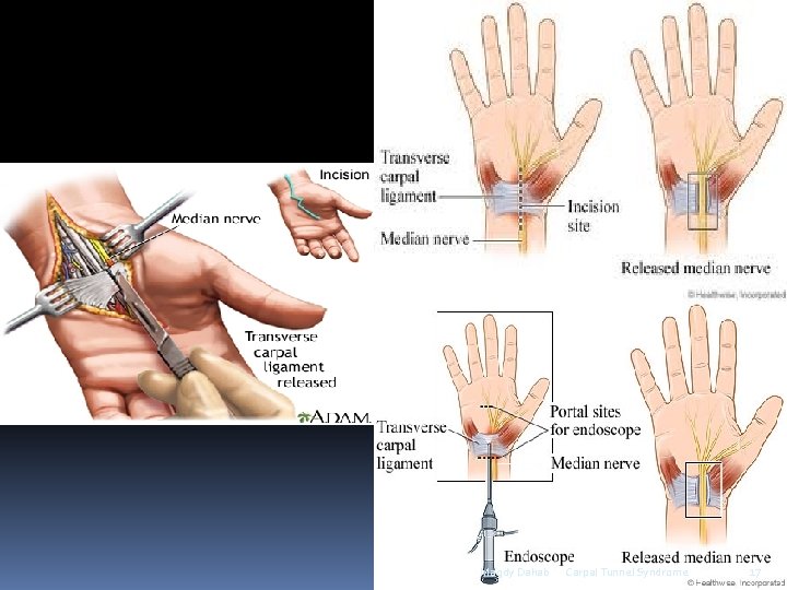 Magdy Dahab Carpal Tunnel Syndrome 17 