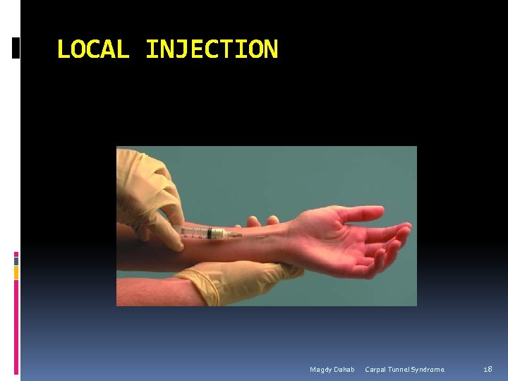 LOCAL INJECTION Magdy Dahab Carpal Tunnel Syndrome 18 