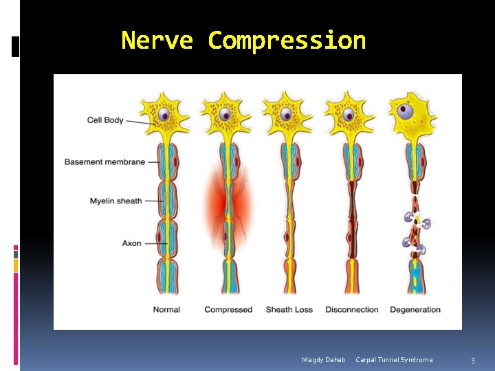 Nerve Compression Magdy Dahab Carpal Tunnel Syndrome 3 