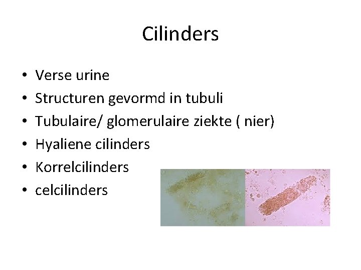 Cilinders • • • Verse urine Structuren gevormd in tubuli Tubulaire/ glomerulaire ziekte (