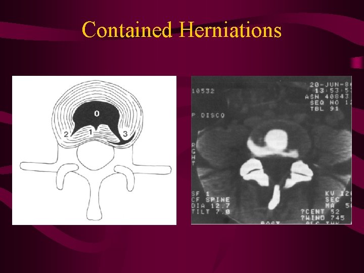 Contained Herniations 