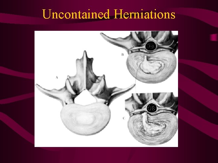 Uncontained Herniations 