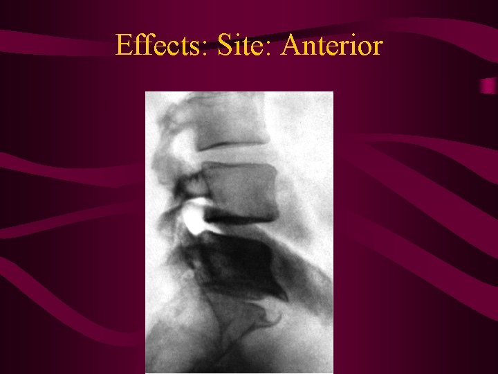 Effects: Site: Anterior 