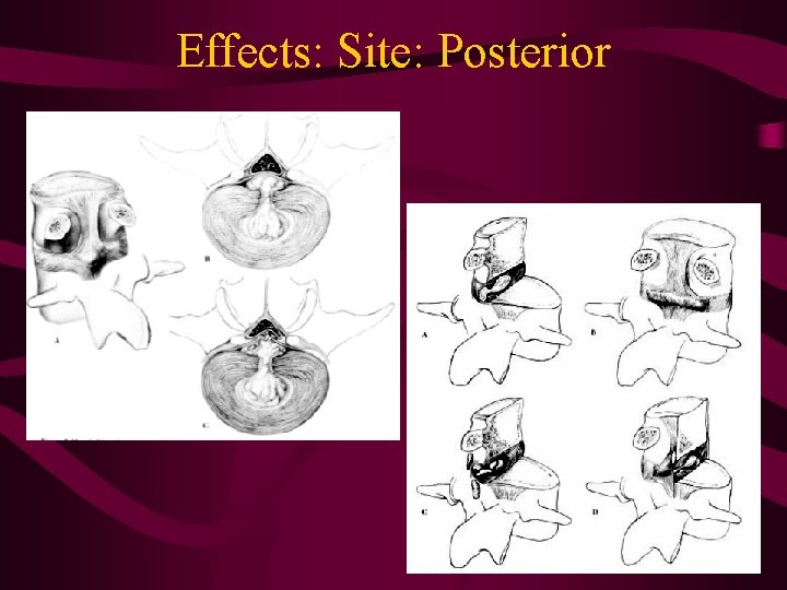 Effects: Site: Posterior 