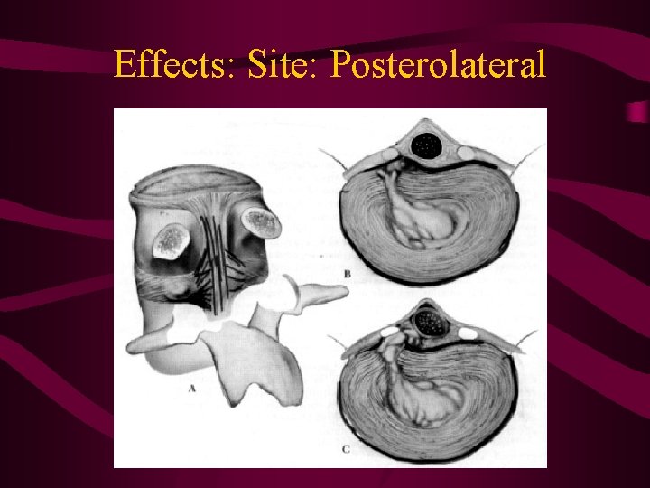 Effects: Site: Posterolateral 