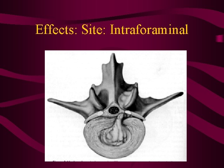 Effects: Site: Intraforaminal 