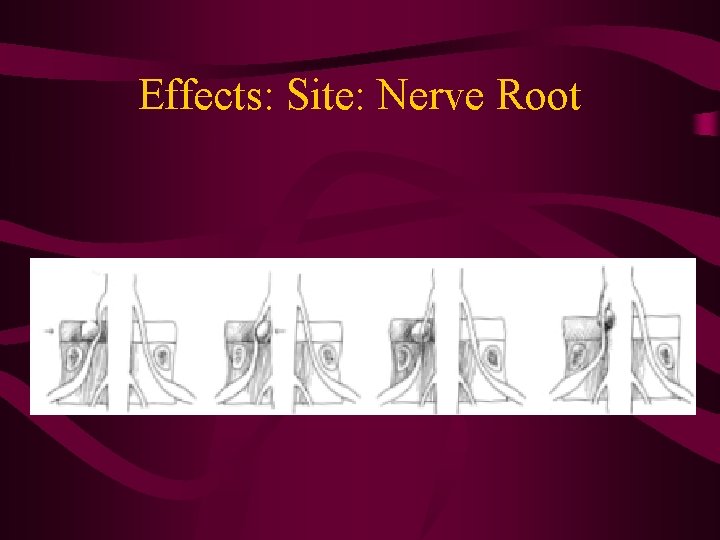 Effects: Site: Nerve Root 