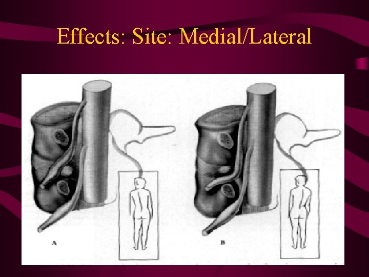 Effects: Site: Medial/Lateral 