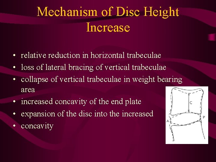 Mechanism of Disc Height Increase • relative reduction in horizontal trabeculae • loss of