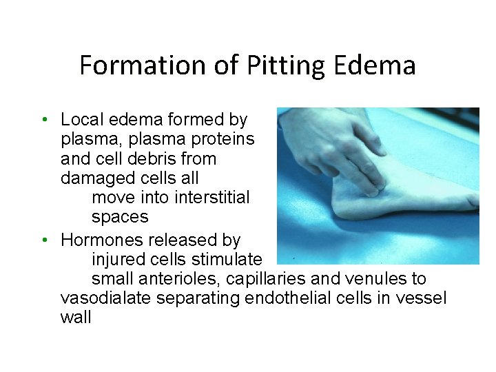 Formation of Pitting Edema • Local edema formed by plasma, plasma proteins and cell