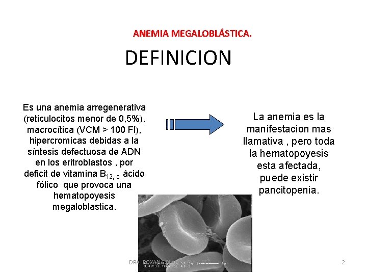 ANEMIA MEGALOBLÁSTICA. DEFINICION Es una anemia arregenerativa (reticulocitos menor de 0, 5%), macrocítica (VCM