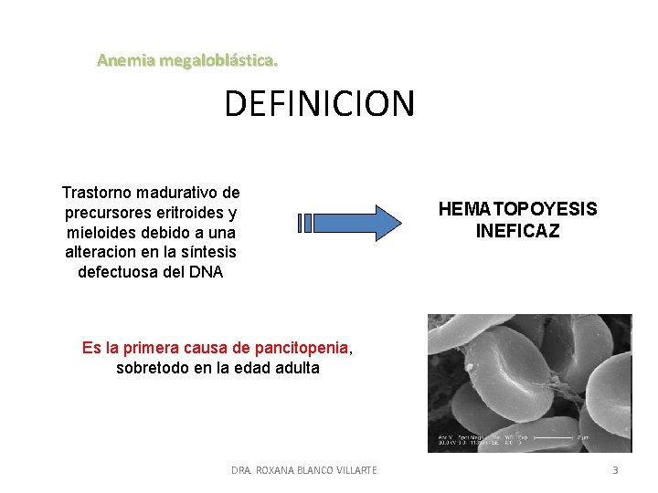 Anemia megaloblástica. DEFINICION Trastorno madurativo de precursores eritroides y mieloides debido a una alteracion