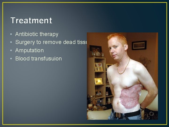Treatment • • Antibiotic therapy Surgery to remove dead tissue Amputation Blood transfusuion 