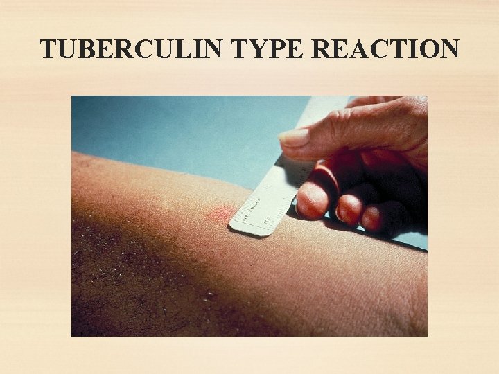 TUBERCULIN TYPE REACTION 